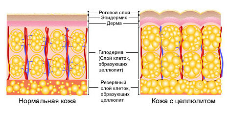 образование между клетками жира ячеистых перемычек волокон коллагена.