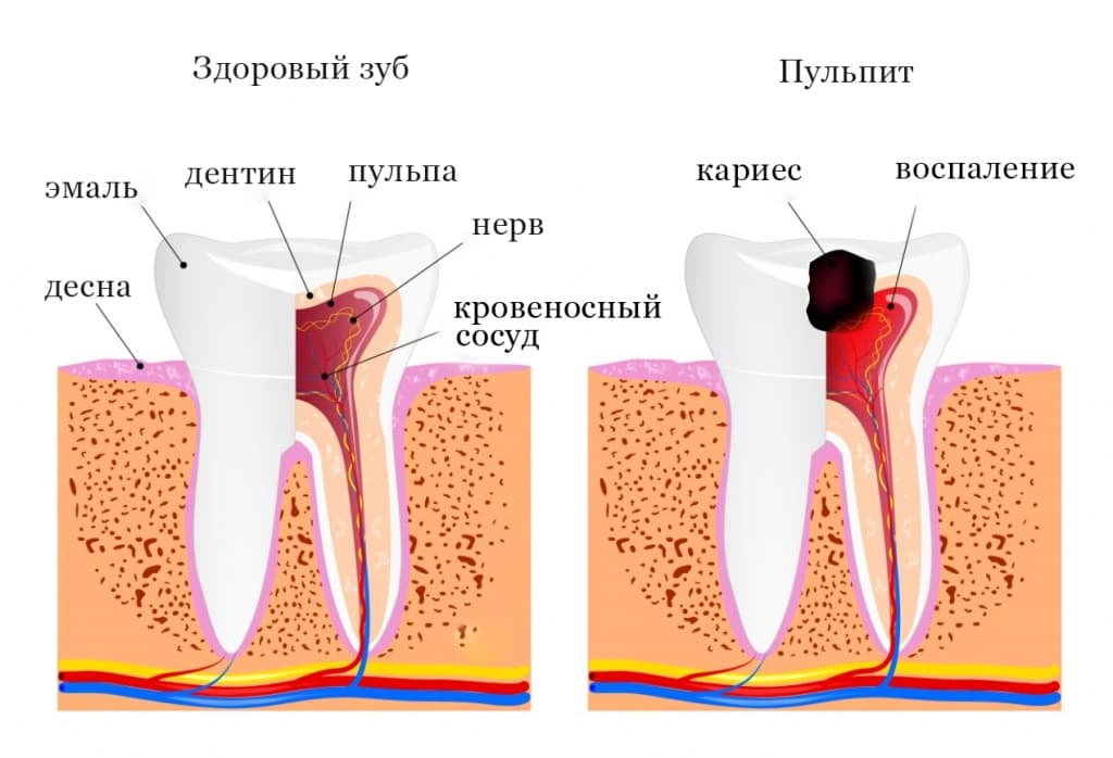Пульпит — симптомы и лечение