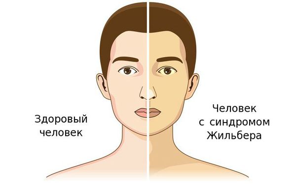 Синдром Жильбера, что делать при обострении